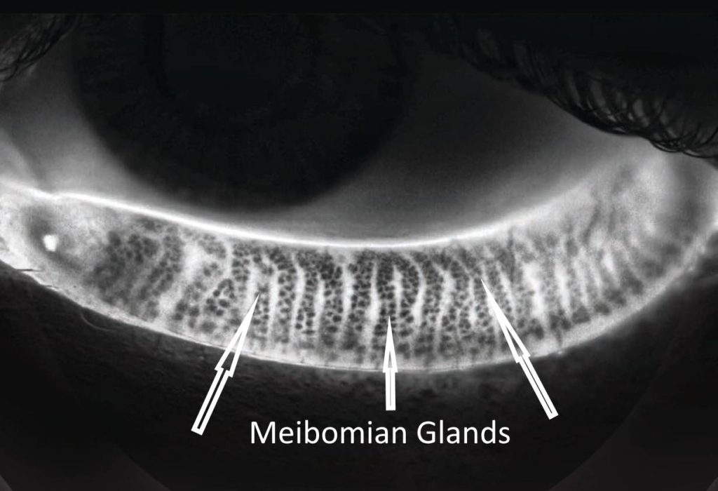 Meibomian Gland Expression Side Effects